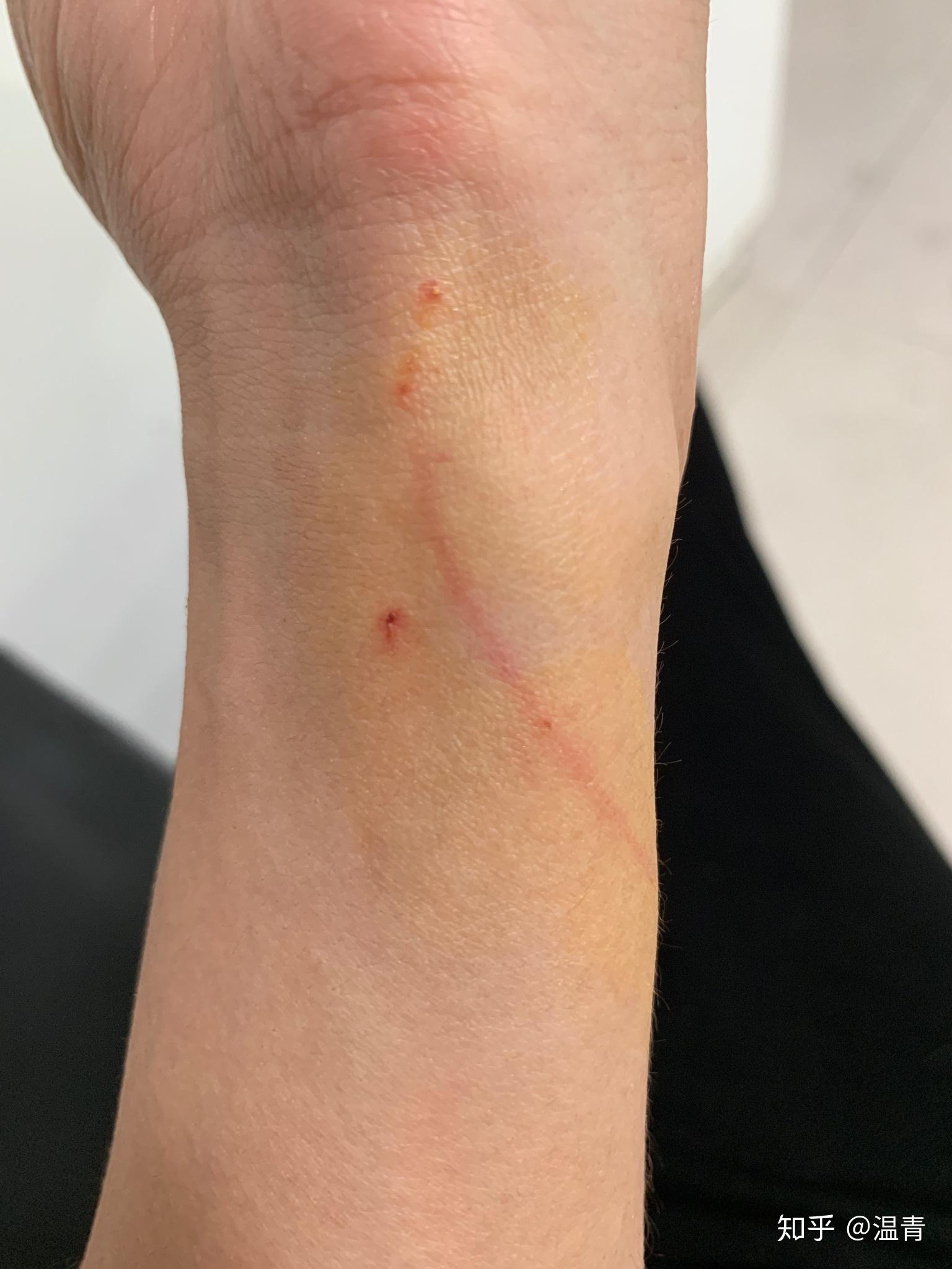 被猫抓出血这种程度需要去打疫苗吗