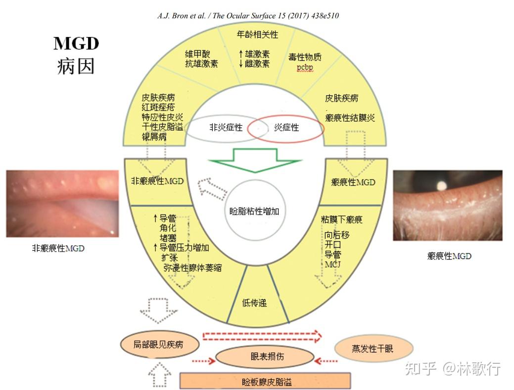 睑板腺功能障碍的病因和发病机制 - 知乎