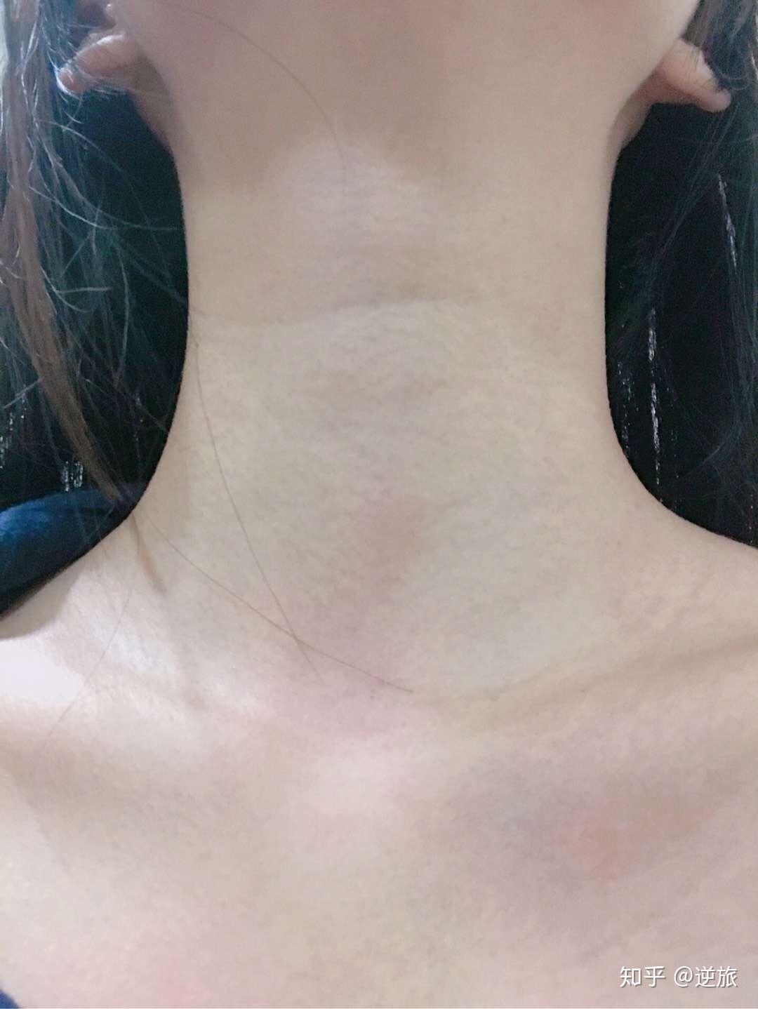 怀孕期间长的颈纹在后期会消吗