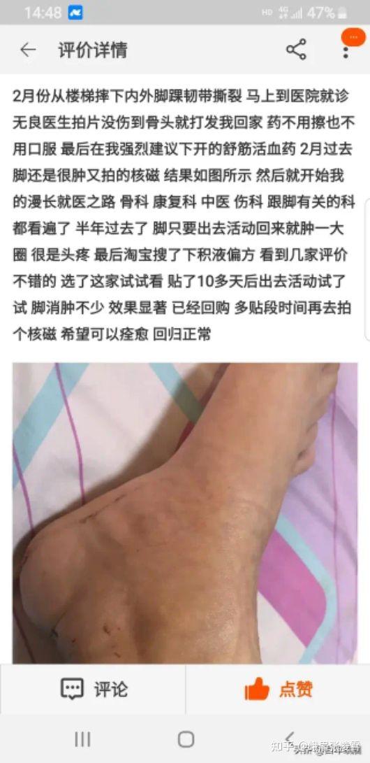 扭伤筋了怎么快速恢复图片