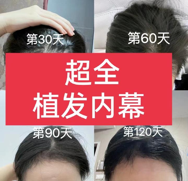植发意义(植发的目的)