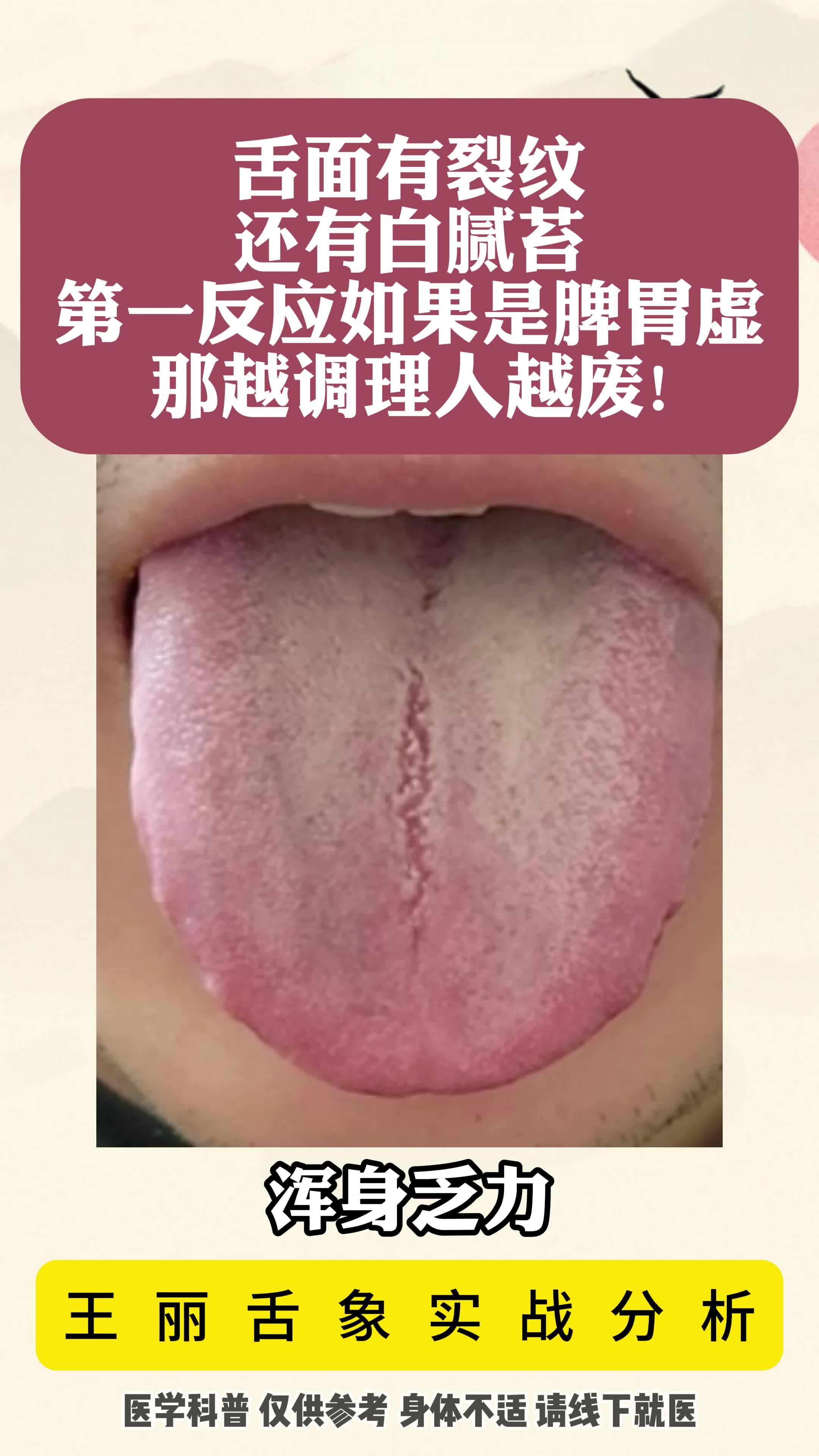 舌面有裂纹 还有黄腻苔,按脾胃虚弱,那越调理人越费!