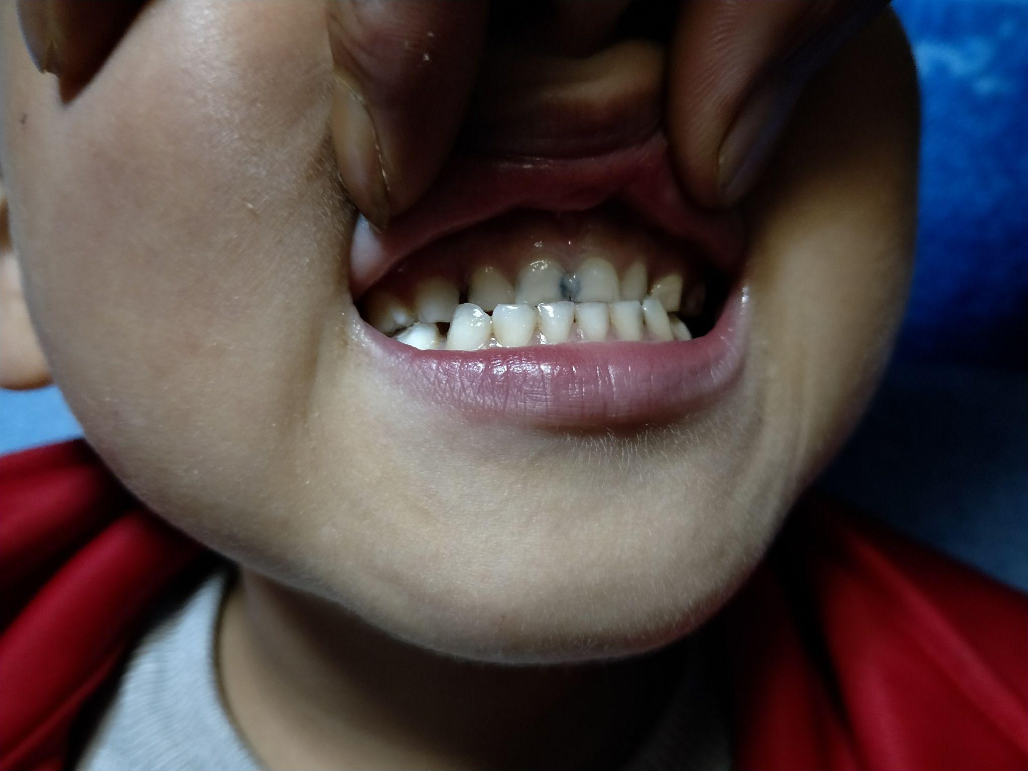 儿童反颌矫正半年后又地包天是复发还是当初没矫正过来