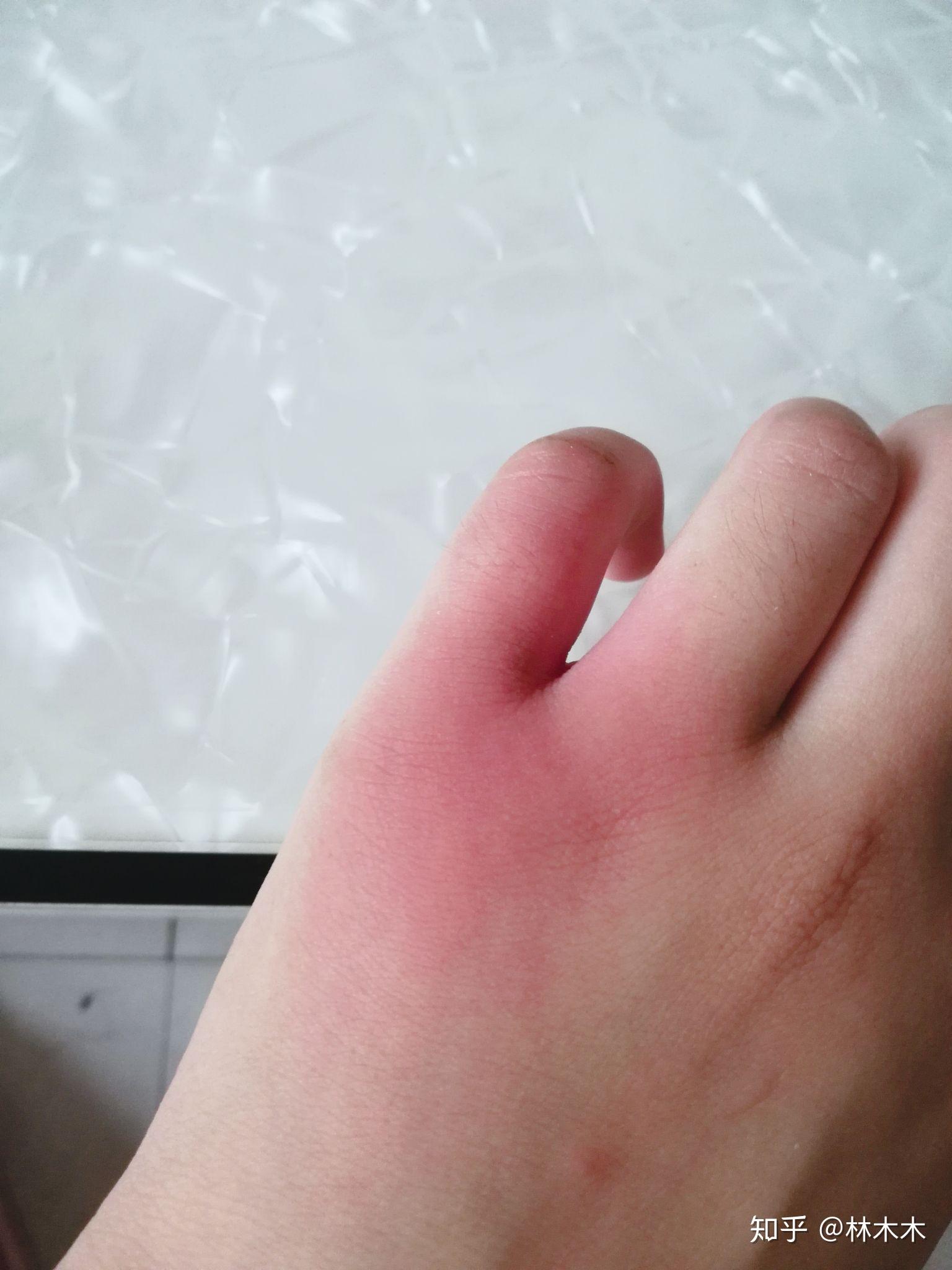 洋辣子有毒吗被蜇后怎么处理