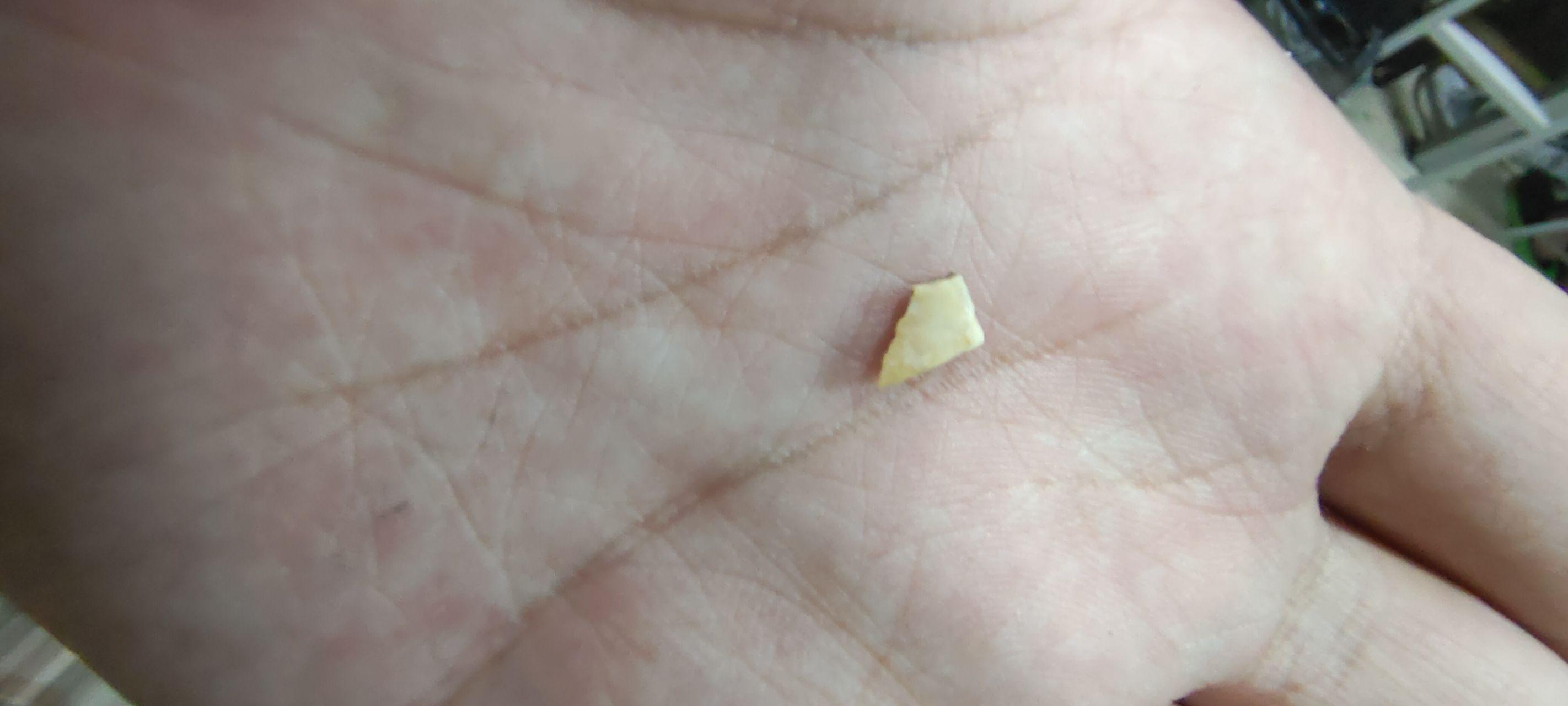 牙结石长什么样? - 知乎