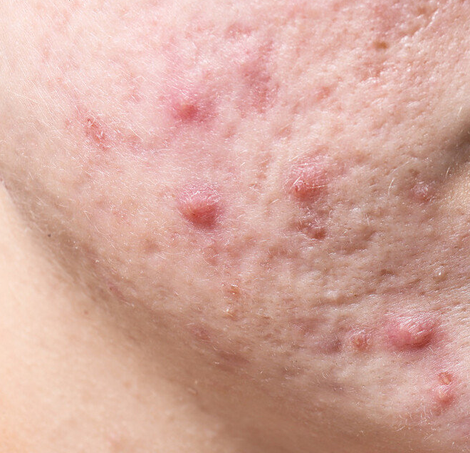 痤疮和湿疹很像,我们应该怎么分辨呢?