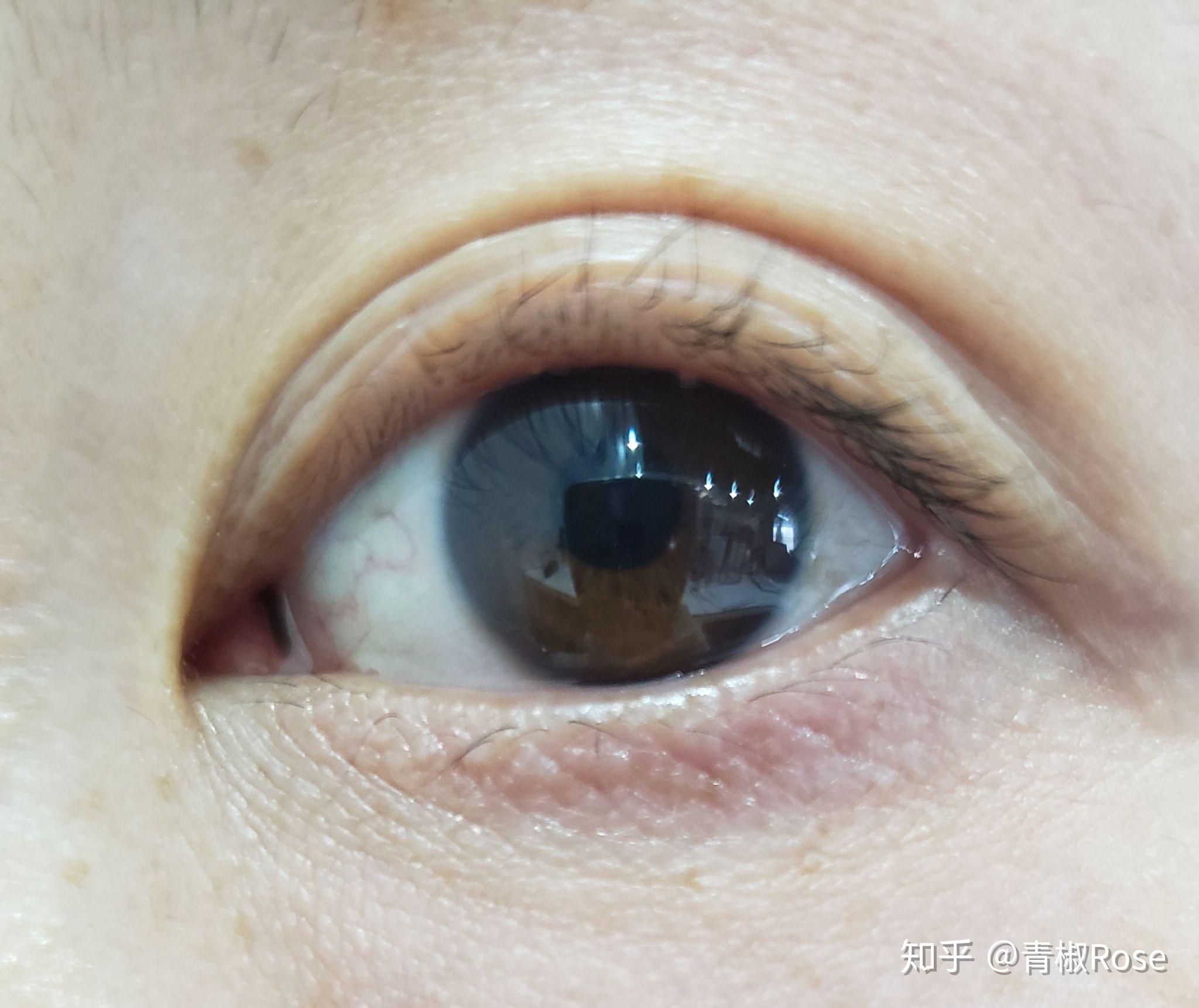 眼角内上面有一个黑色似小肉块的东西是什么? - 知乎
