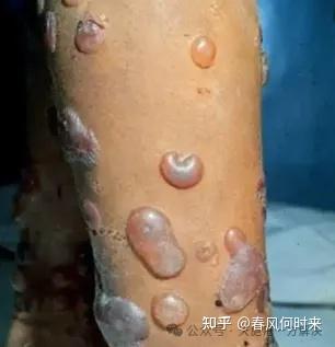 从溃烂到愈合,健脾祛湿方剂终结天胞疮