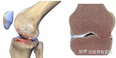 漫谈骨关节炎（1）-- 骨关节炎的形成与症状 - 知乎