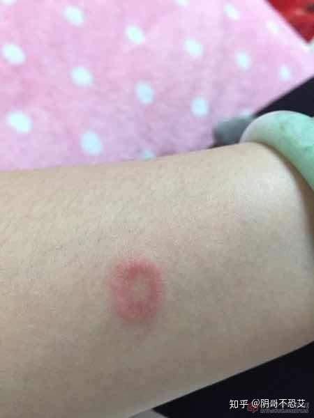 请问这是梅毒潜伏期的症状吗