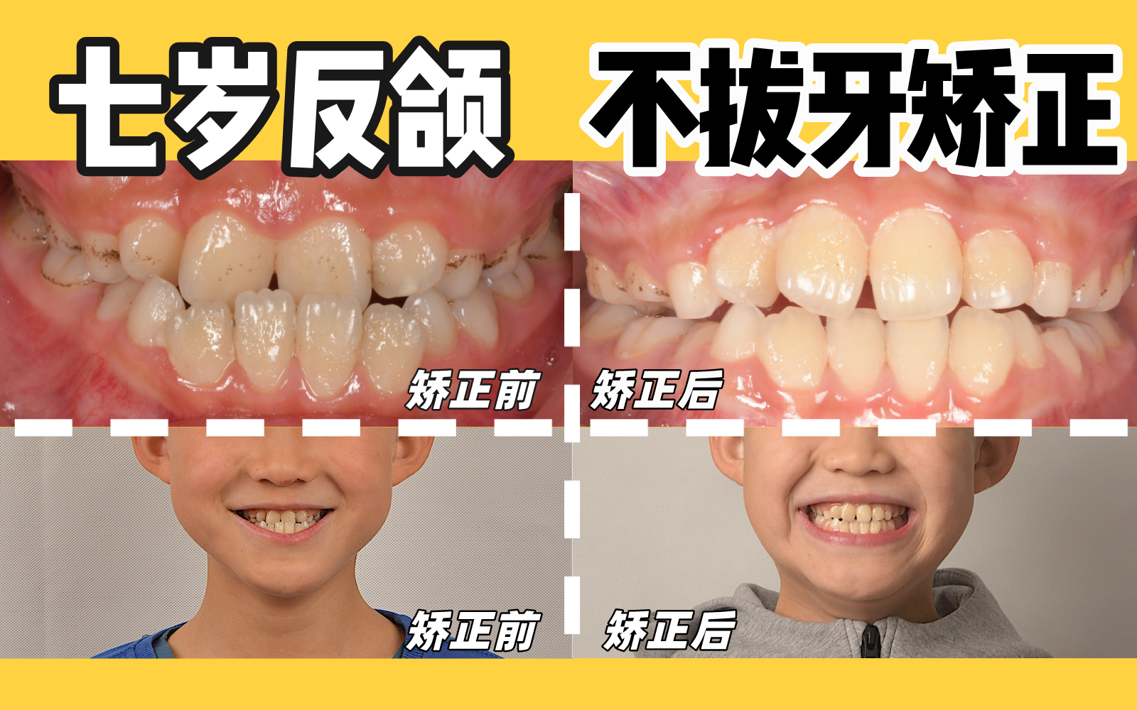 反颌(地包天)矫正的最佳年龄是几岁?