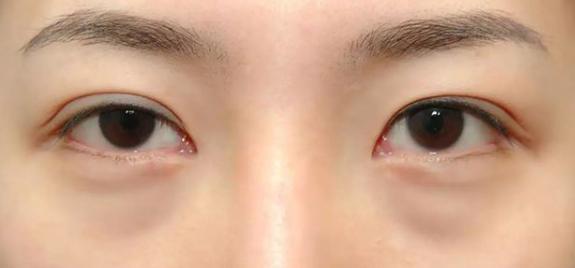 因为短时间内熬夜形成的眼袋我们称为水肿型假性眼袋一般是暂时的根据