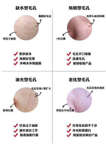 油皮毛孔粗大怎么改善? - 知乎
