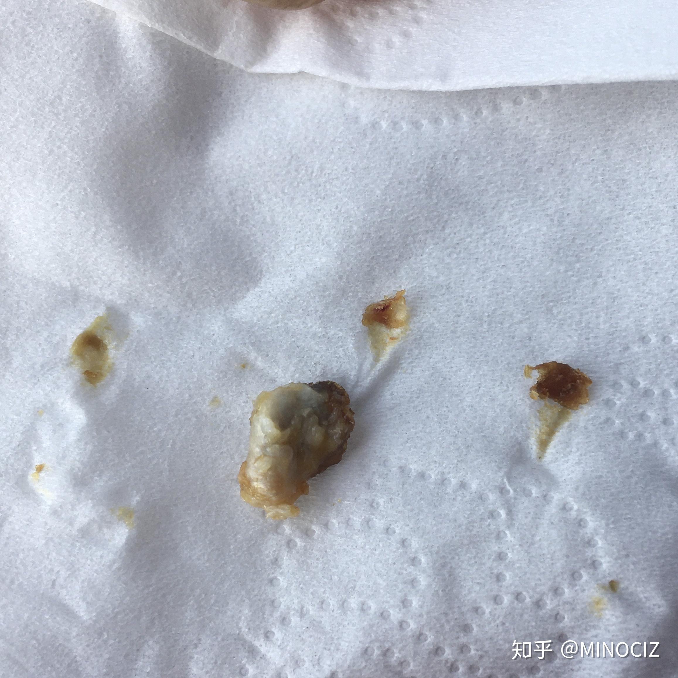 掏出一块超大耳屎是种什么体验