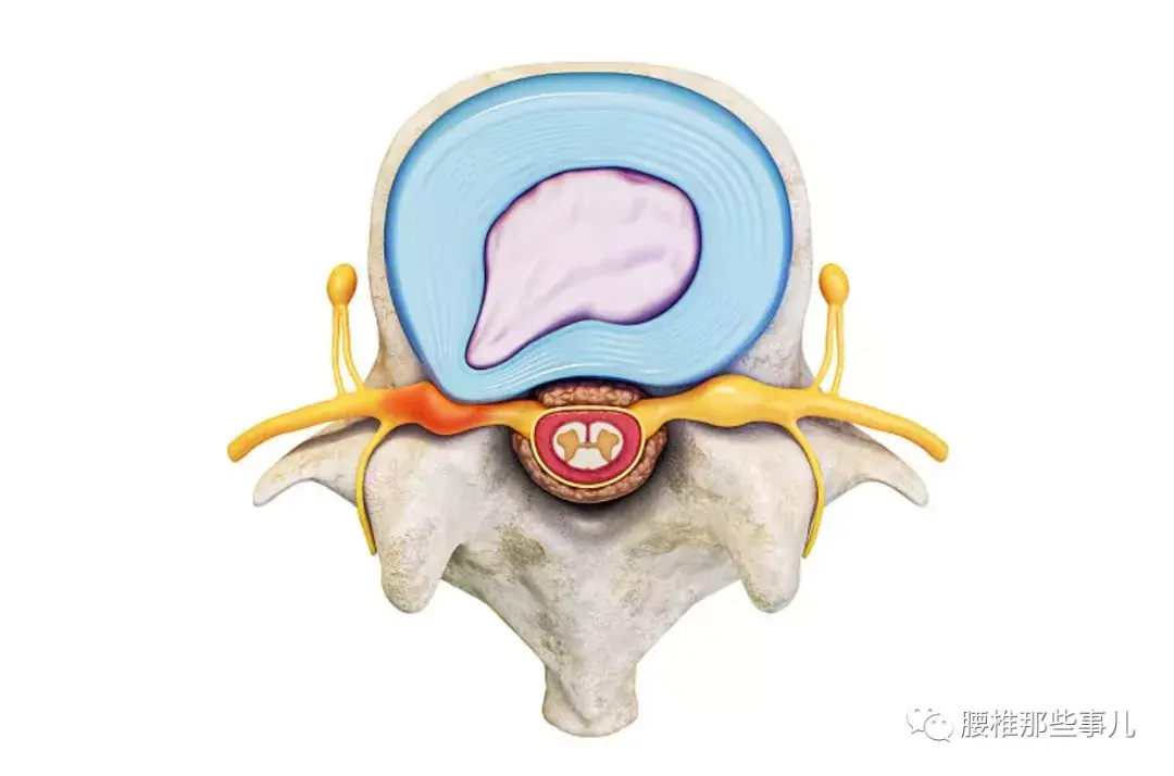 椎間盤膨出怎樣防止變成突出呢? - 知乎