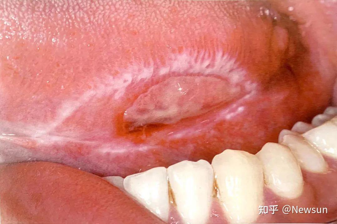 盘状红斑狼疮有哪些症状表现? - 知乎