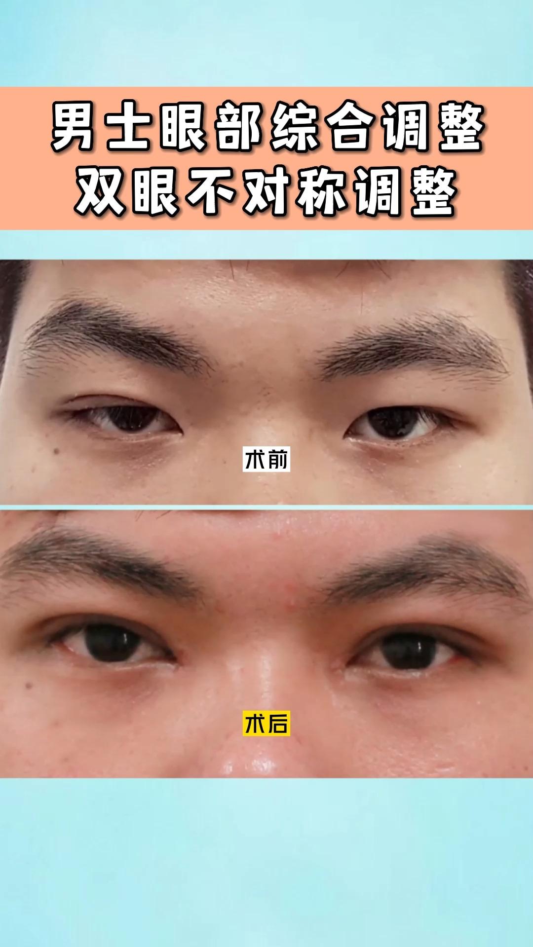 男士眼综合术后一周效果对比真明显