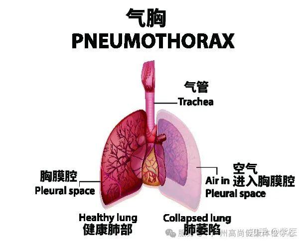 歌手因病去世，曾因气胸多次入院 | 气胸高发于瘦高男性、吸烟者，胸痛呼吸困难要注意 - 知乎