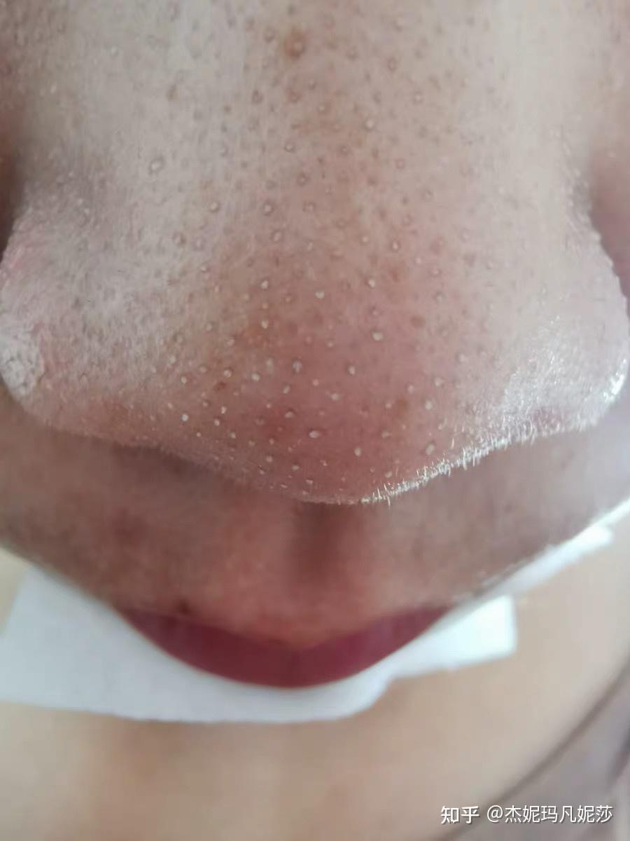 脸上的毛孔里经常出现白色的油脂小颗粒,如何根除? - 知乎
