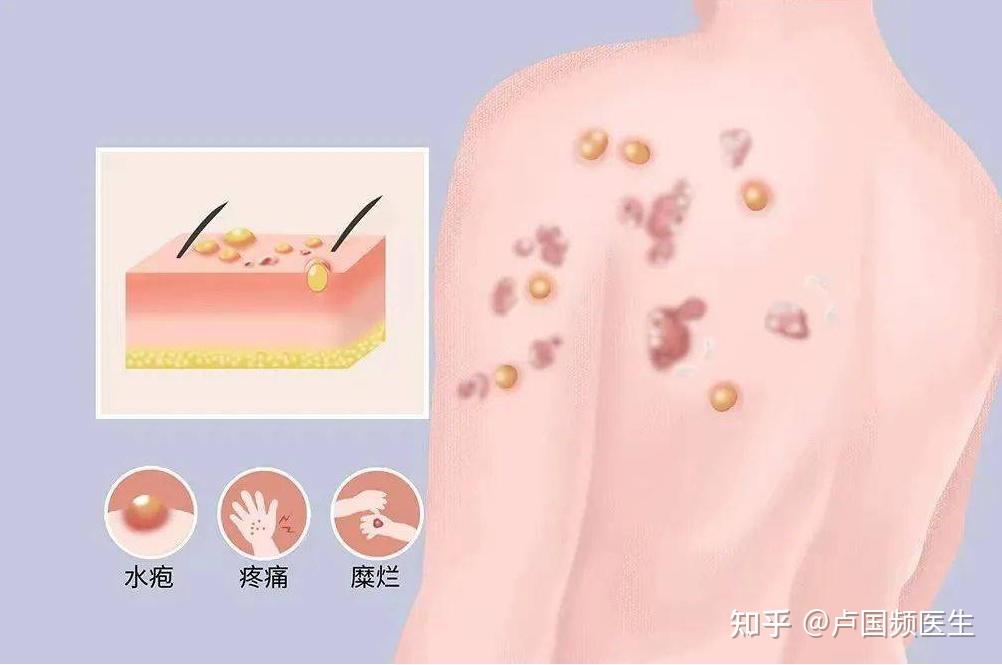 丹毒到底是哪一类病?有什么表现呢? - 知乎