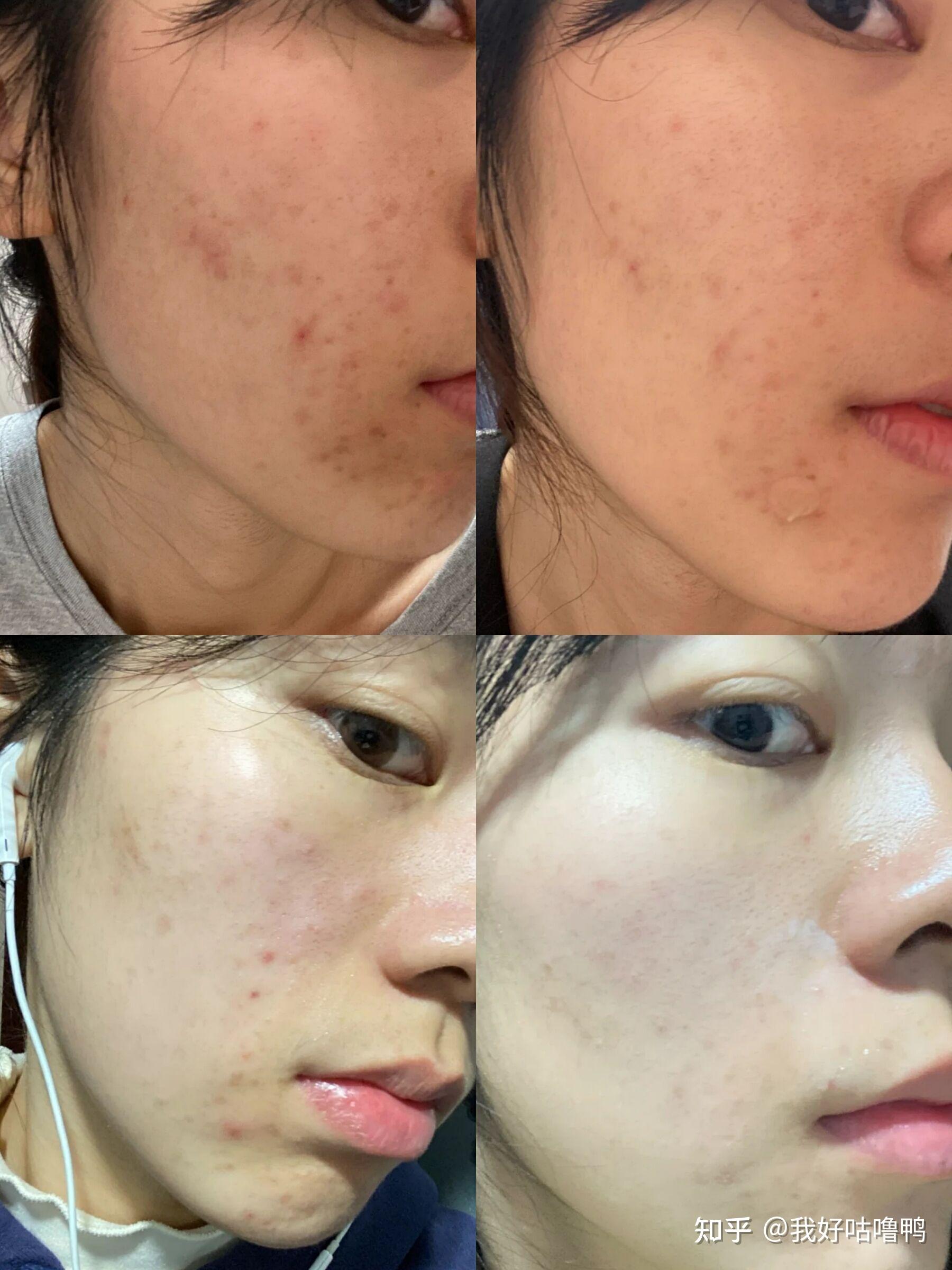 脸上的痘印怎样消除_脸上的痘印怎样消除最有效