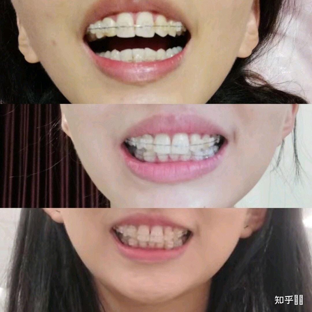 如果只是前两颗大门牙前突严重,必须要戴牙套吗?