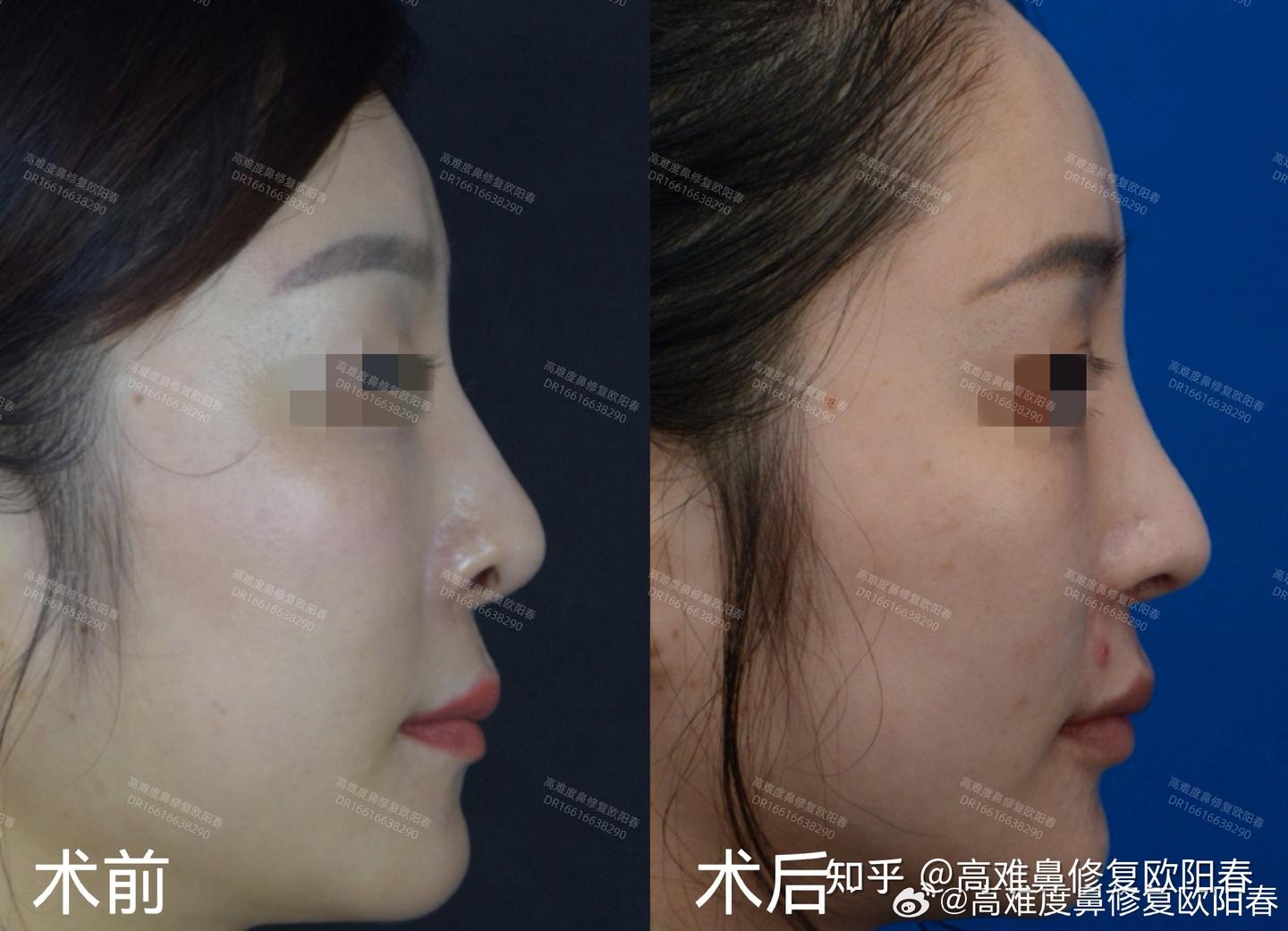 鼻翼缘退缩和露鼻孔有什么区别? - 知乎