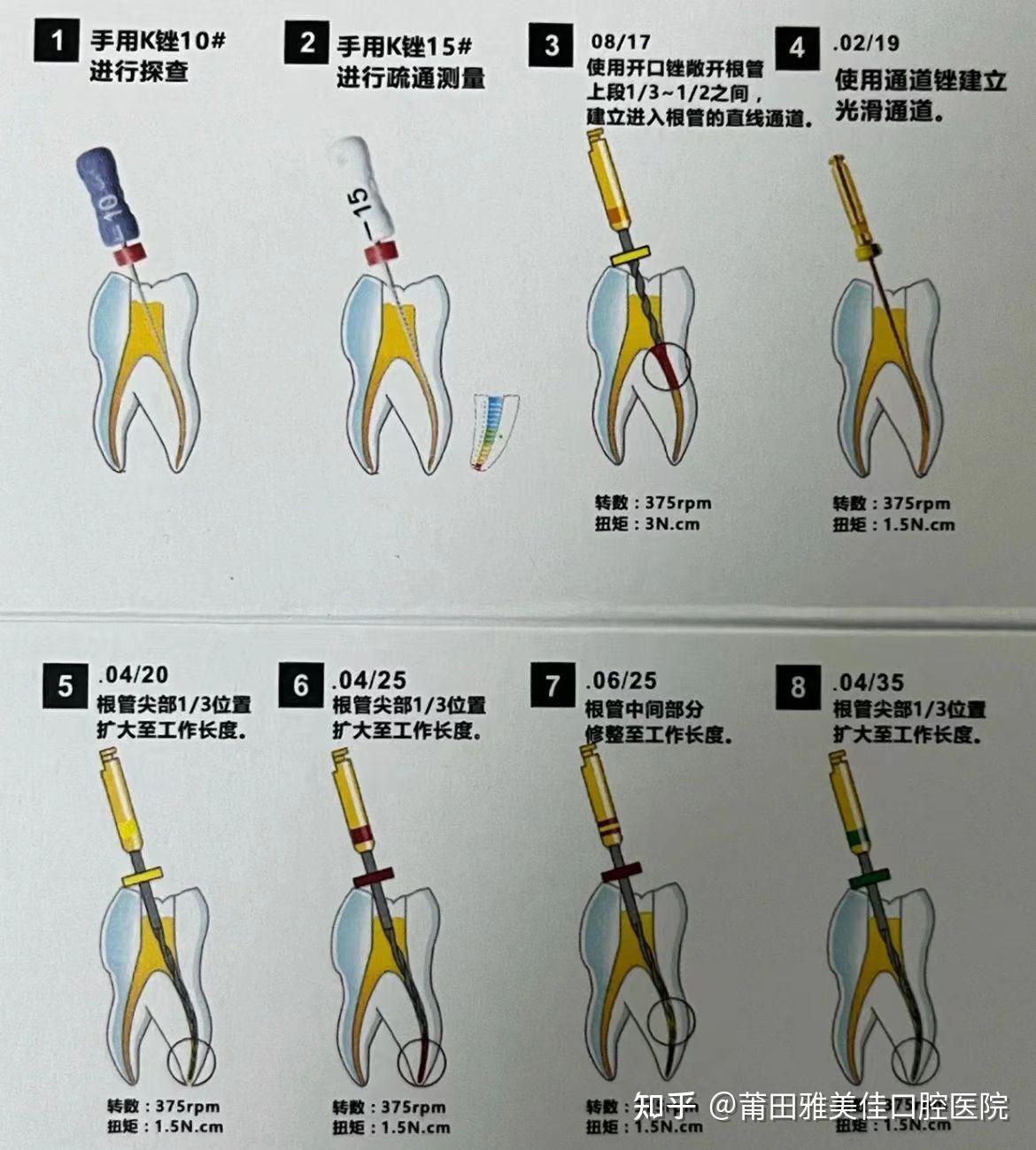根管治疗的步骤是什么? - 知乎