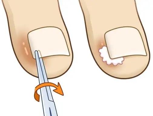 邯郸甲沟炎一定要拔甲吗