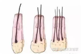 额角秃了怎么办?进行额角植发需要多少毛囊? - 知乎