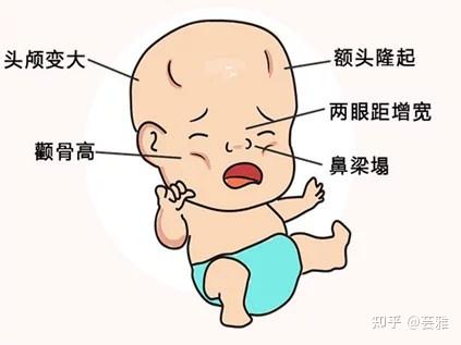 地中海贫血症,孩子表现型如何?