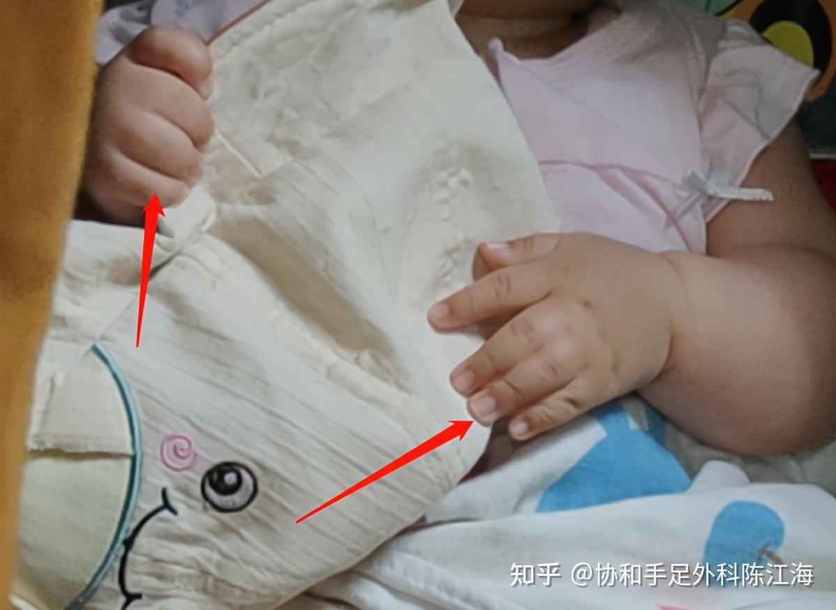 并指的病因是什么?不同类型的并指术后效果(一) - 知乎