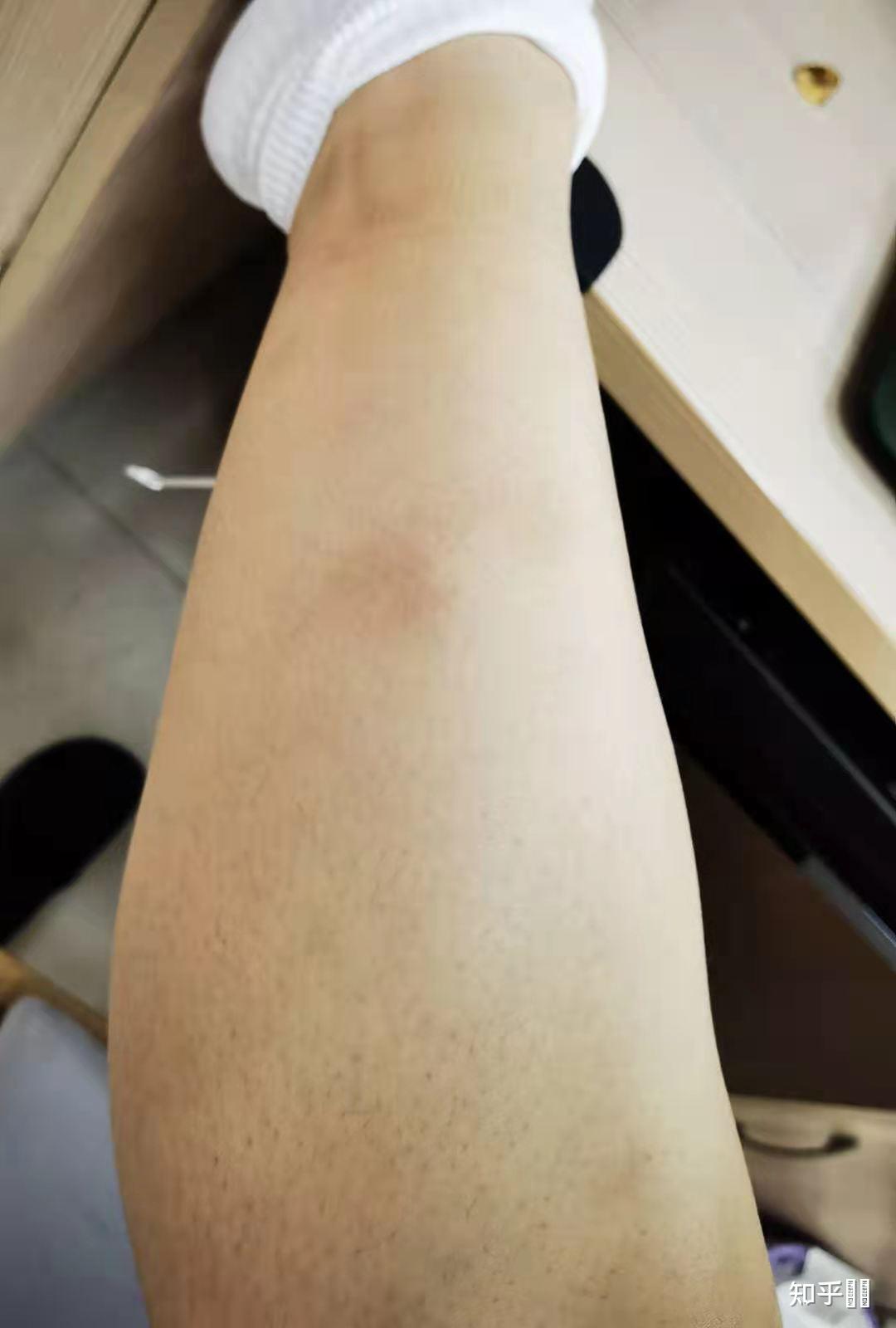 得过结节性红斑的人过来交流下? - 知乎