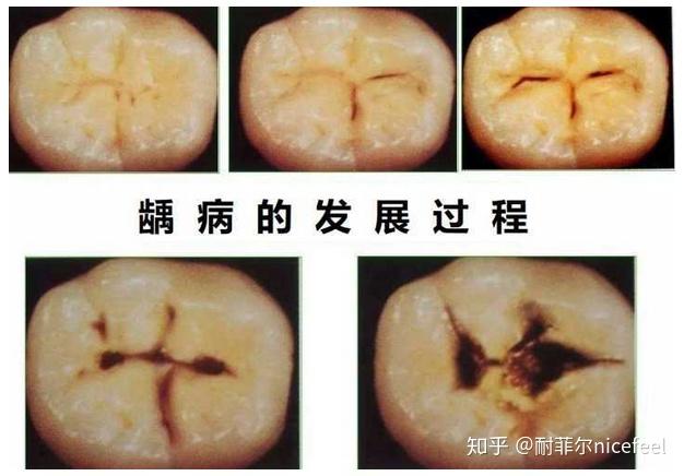得了龋齿,如何自我判断严重程度? - 知乎