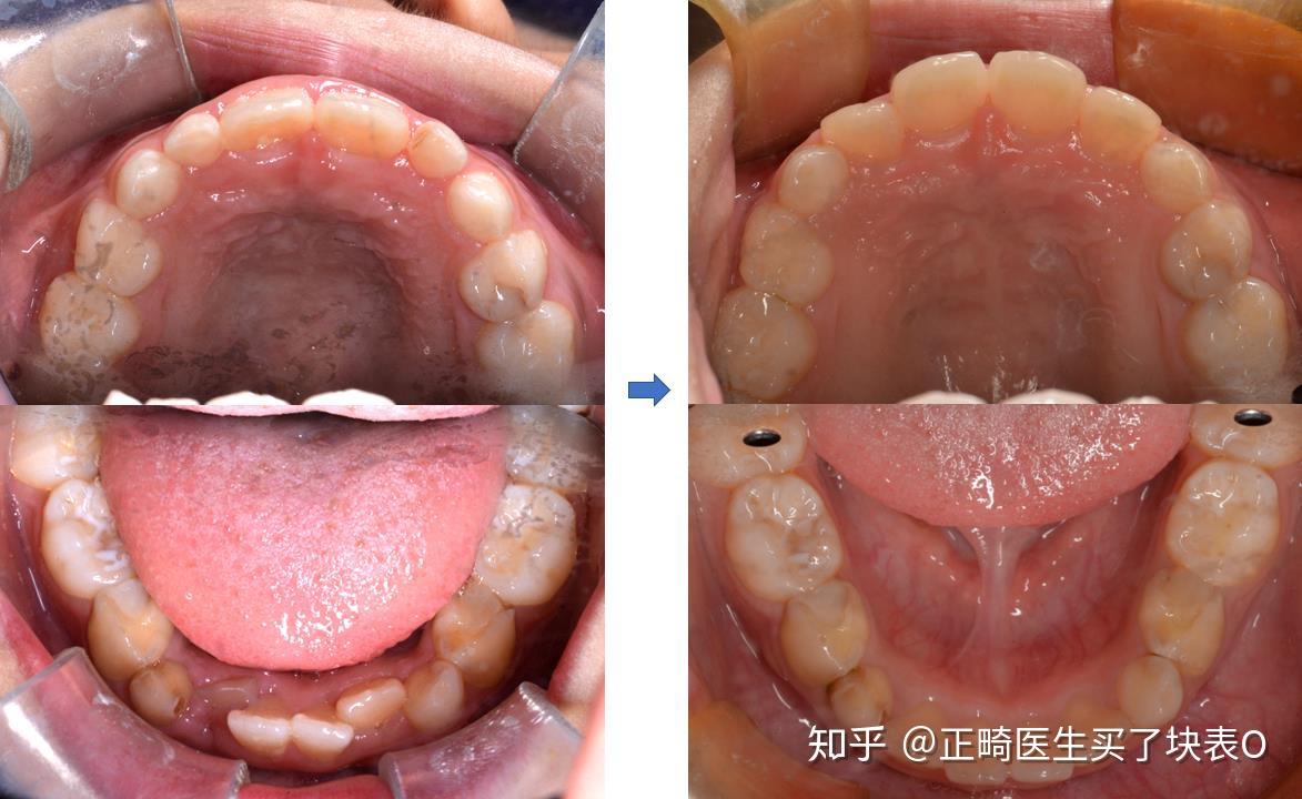 哪位大神能说下芬兰罗慕齿美康对早期幼儿牙齿矫正有没有作用