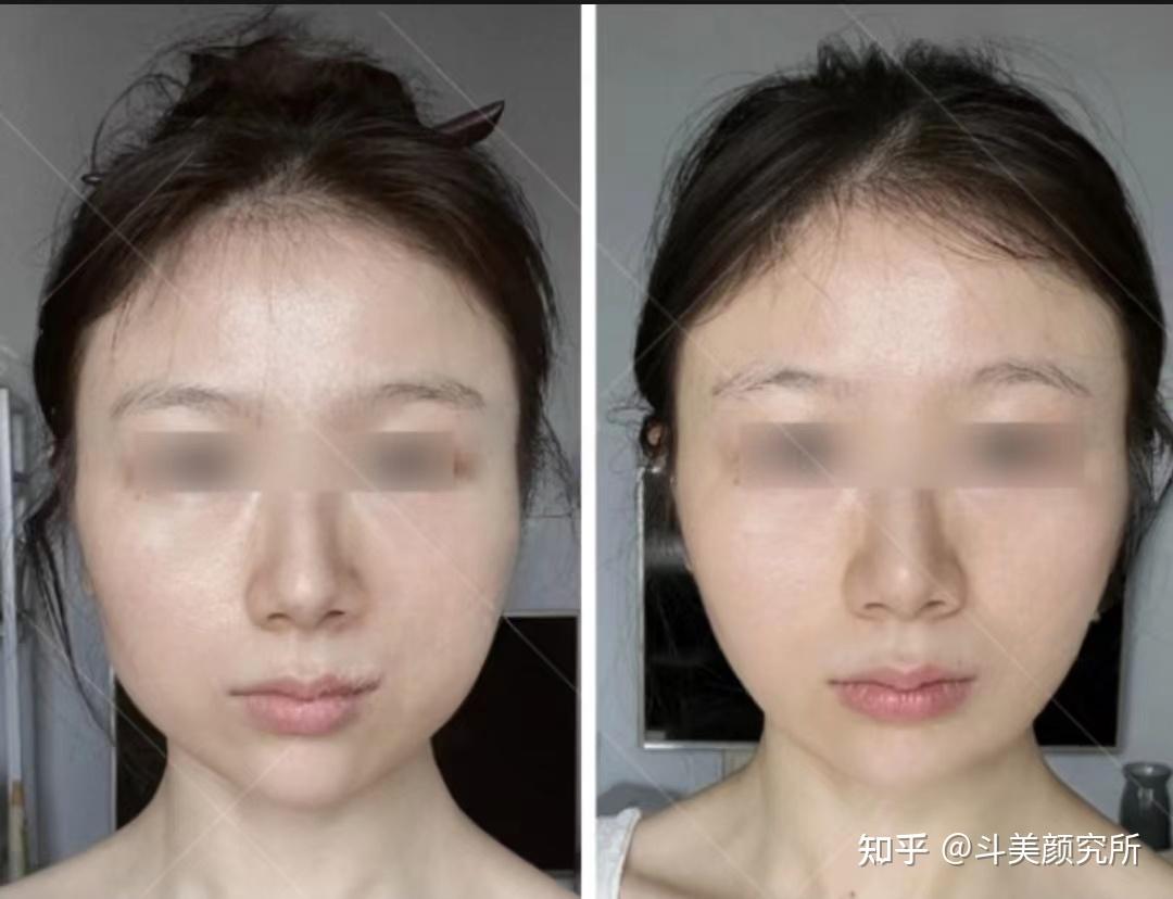 方脸变美攻略:方脸怎么远离土气变高级,医美、发型、配饰一文讲清楚,方形脸姐妹必看!!! - 知乎