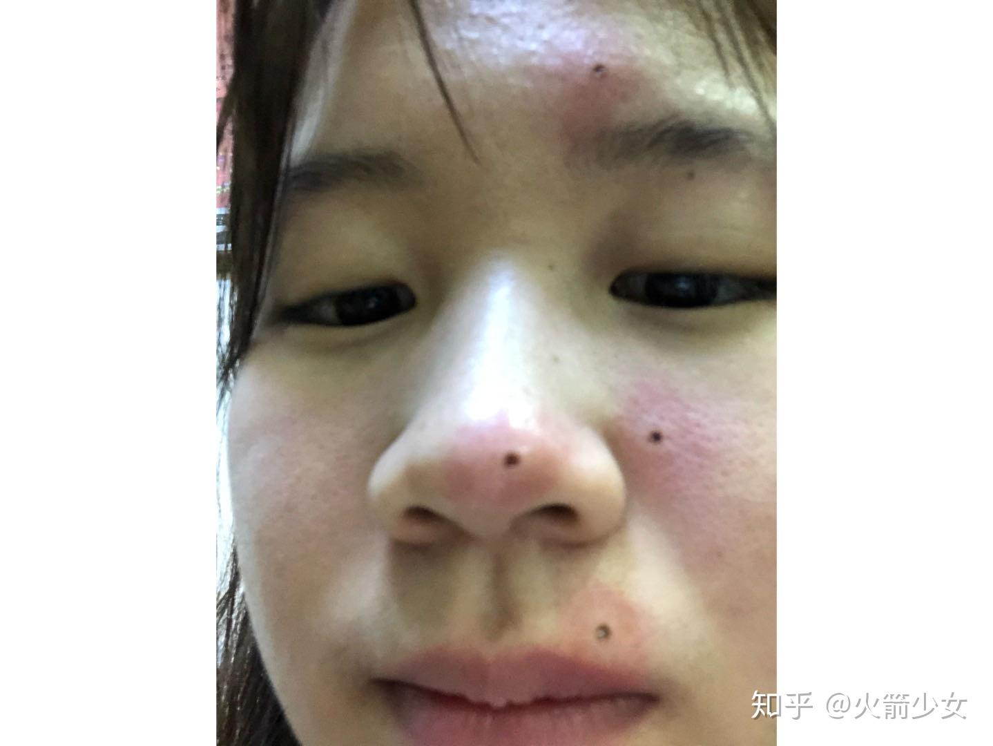 点痣是不是很容易又长出来？ - 知乎