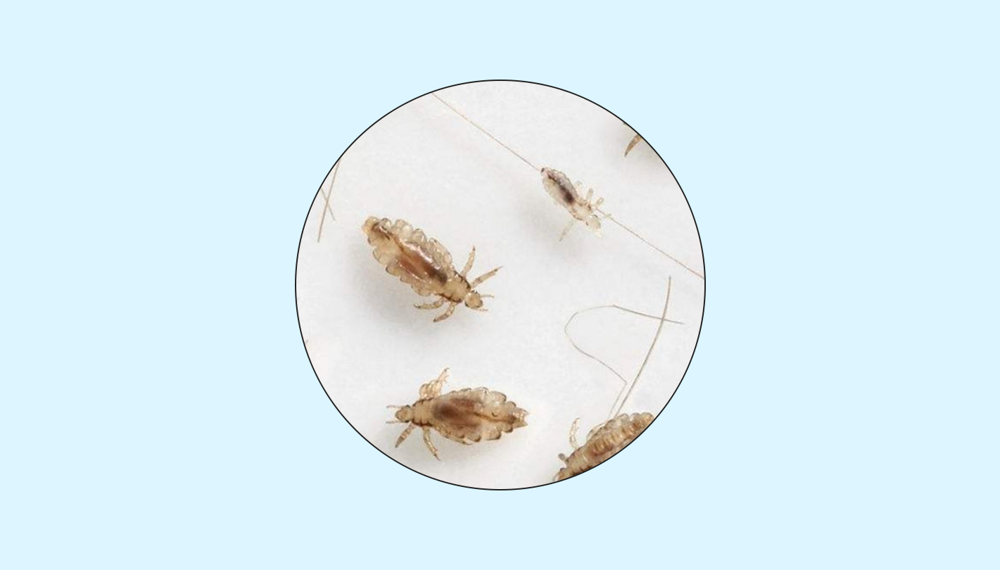 怎样区别头发上是螨虫还是虱子? - 知乎