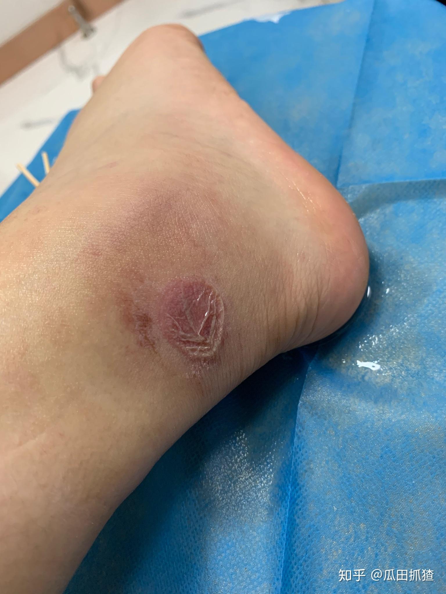 被隐翅虫咬了会怎么样