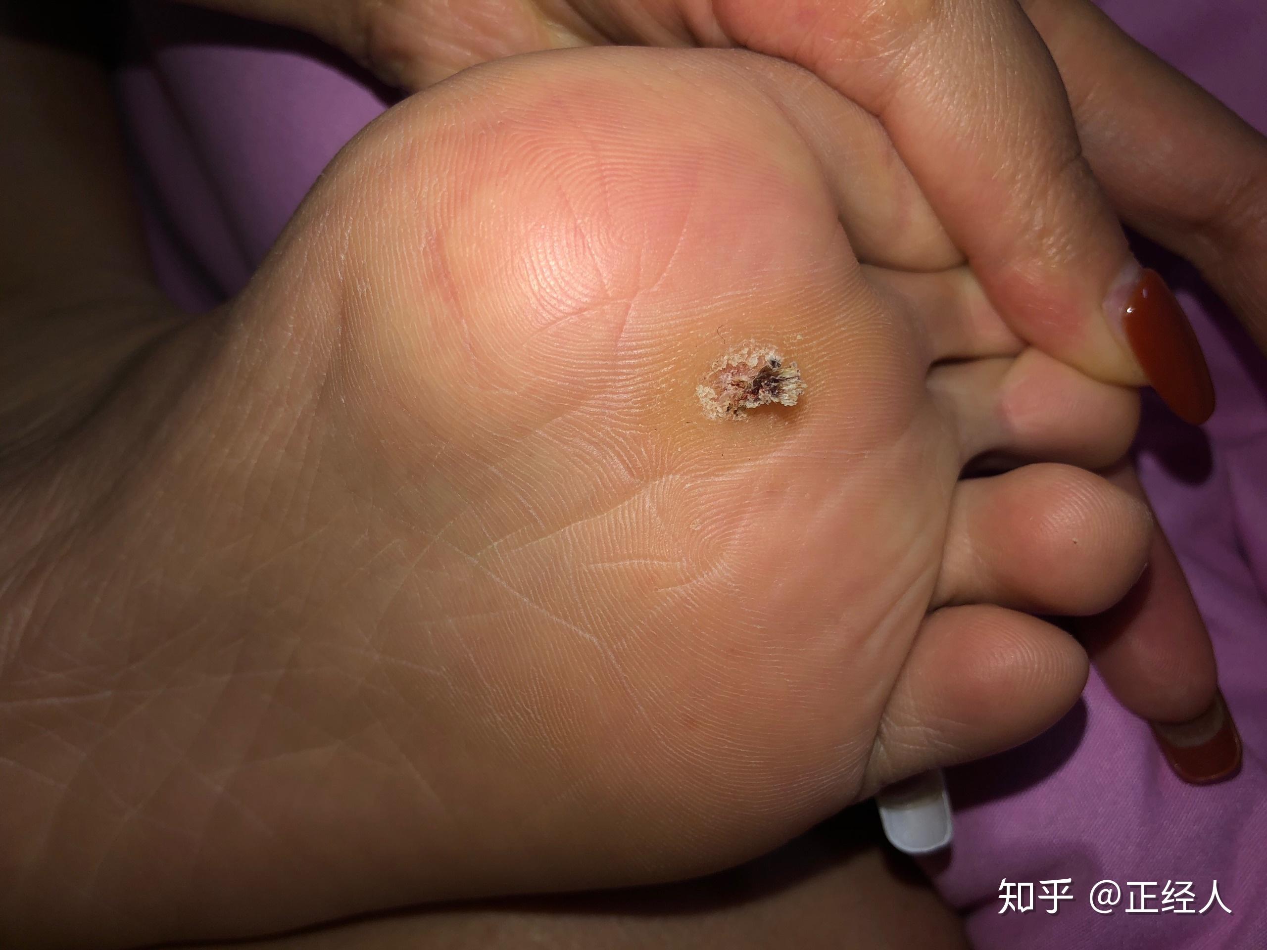 跖疣的自愈性大吗