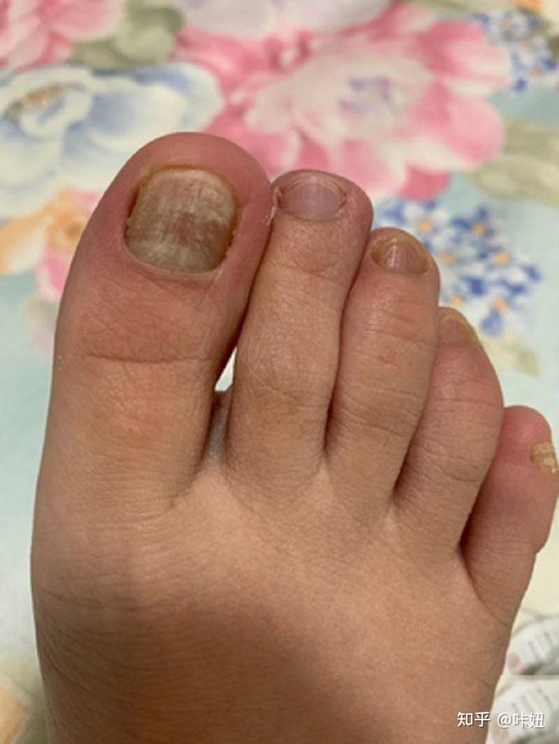 我的这种情况是灰指甲前期症状吗
