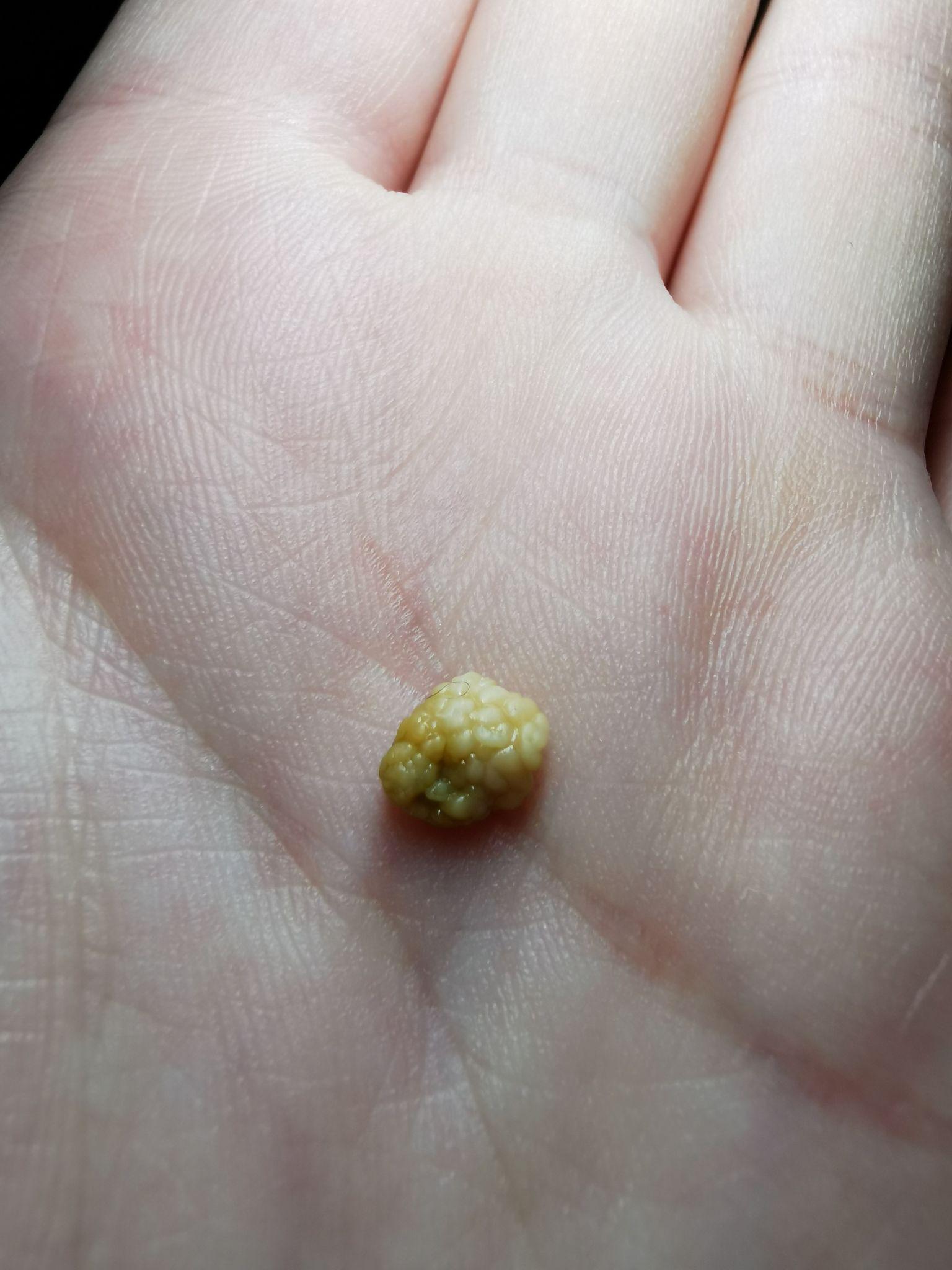 你见过最大的扁桃体结石有多大