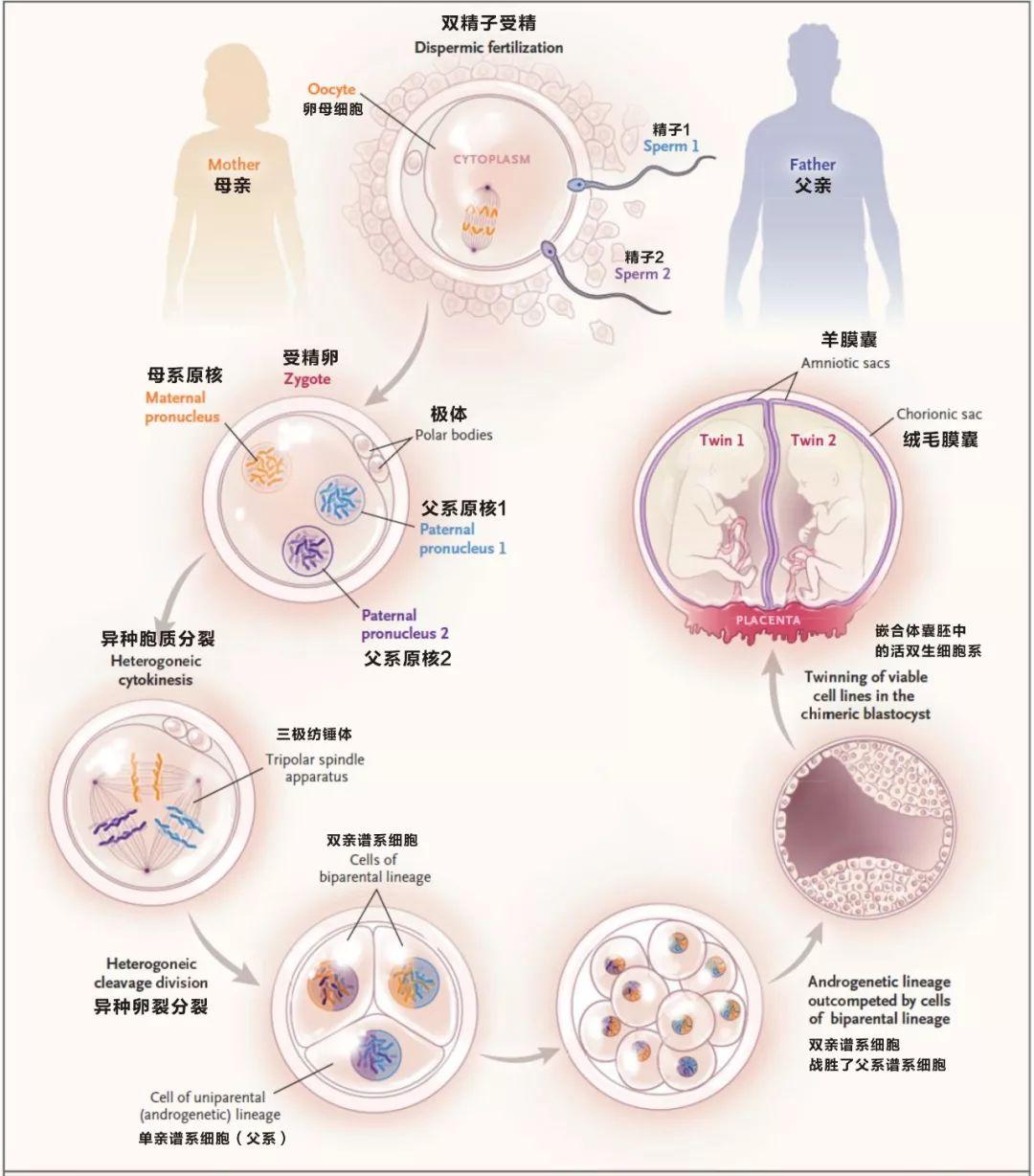 NEJM报道全球最罕见的双胞胎类型:由两个精子进入同一个卵母细胞产生 - 知乎
