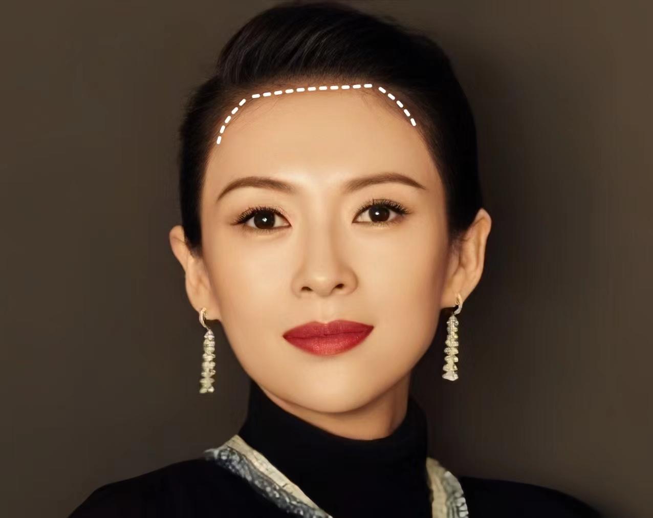 植发选什么发际线形状形状决定是否能改善脸型不适合的形状反向植发