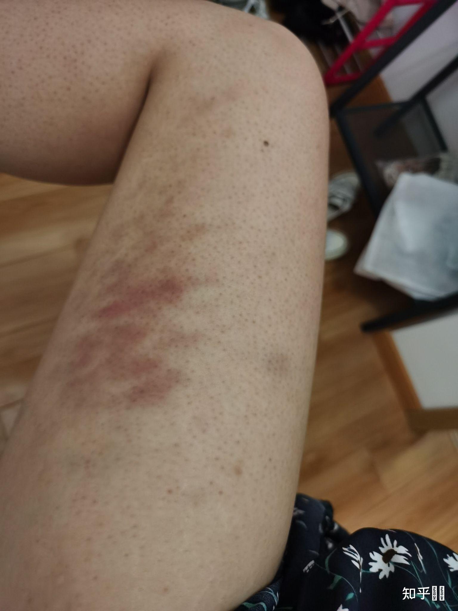 有没有人试过腿部刮痧? - 知乎