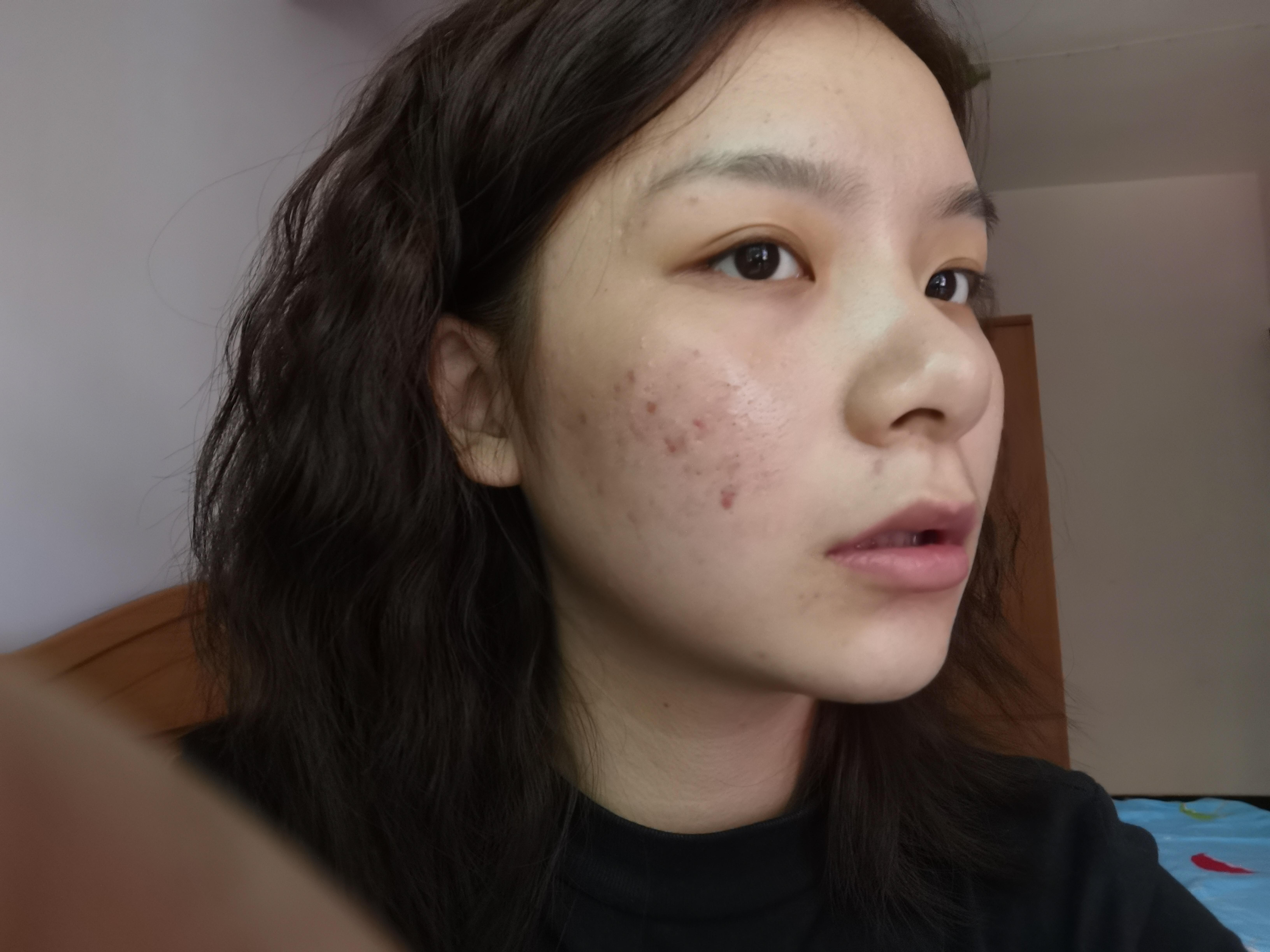 有没有长得好看但长痘痘的女生? - 知乎