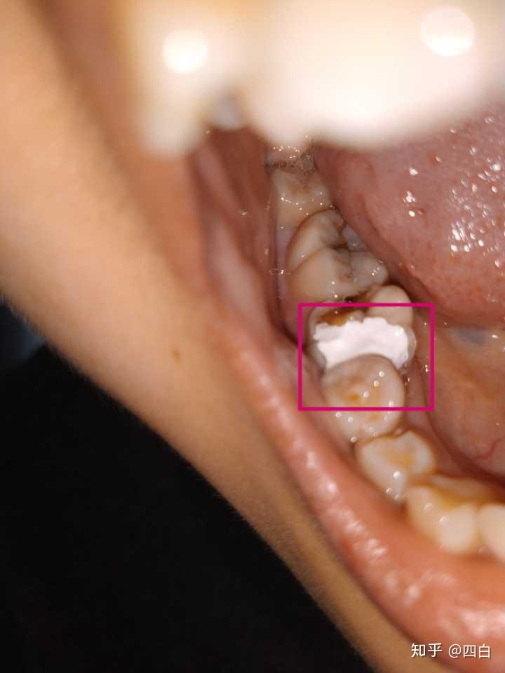 根管治疗疼不疼?