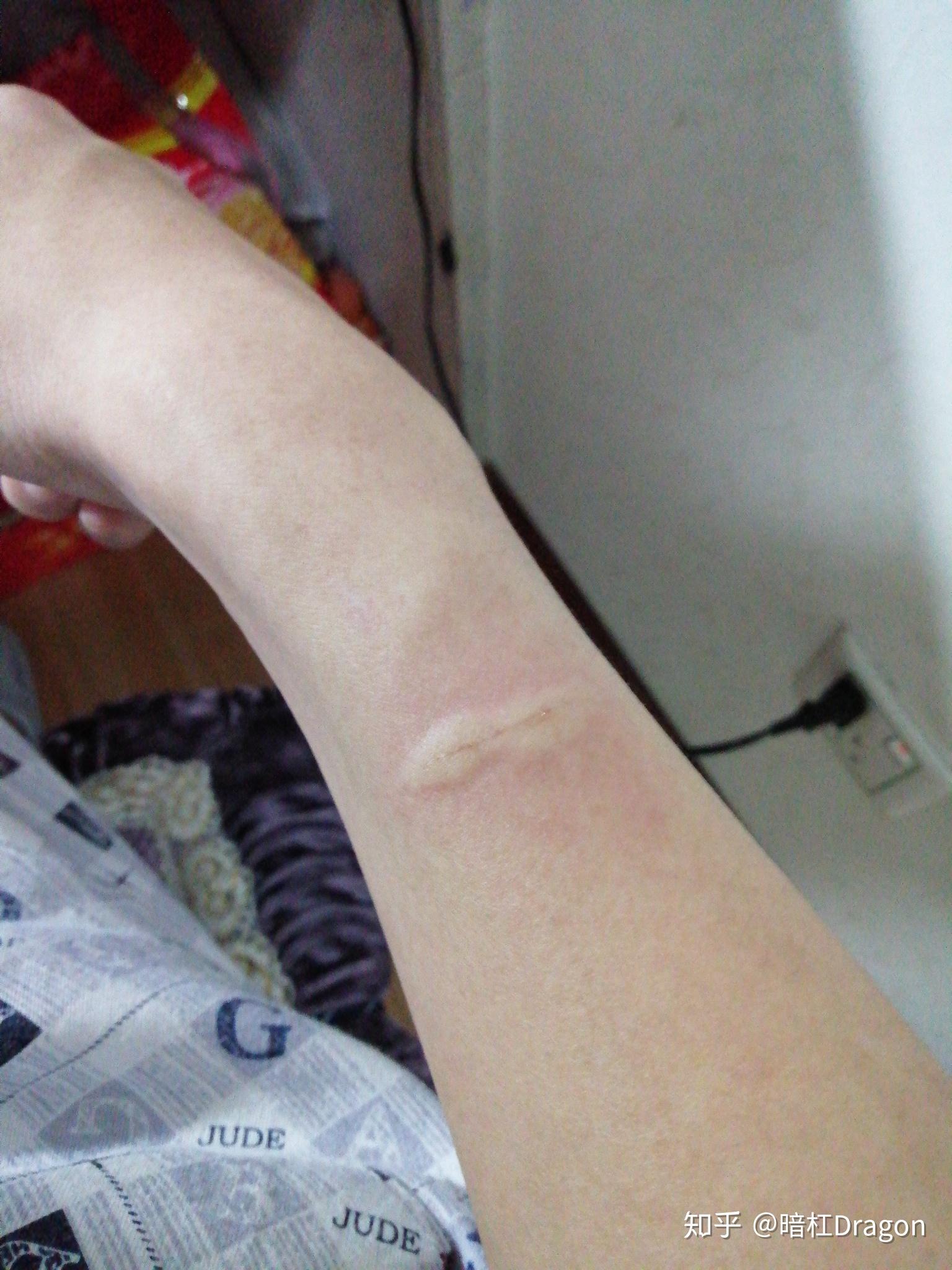 被家养的两个月小奶猫抓伤伤口不深它没打过针我需不需要打针可不可以