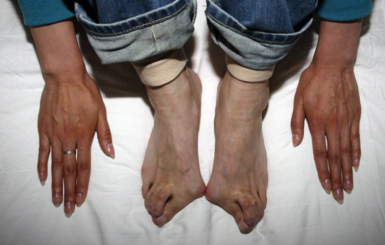 博尔特双脚为什么会变形,职业田径运动员的脚都会这样吗?