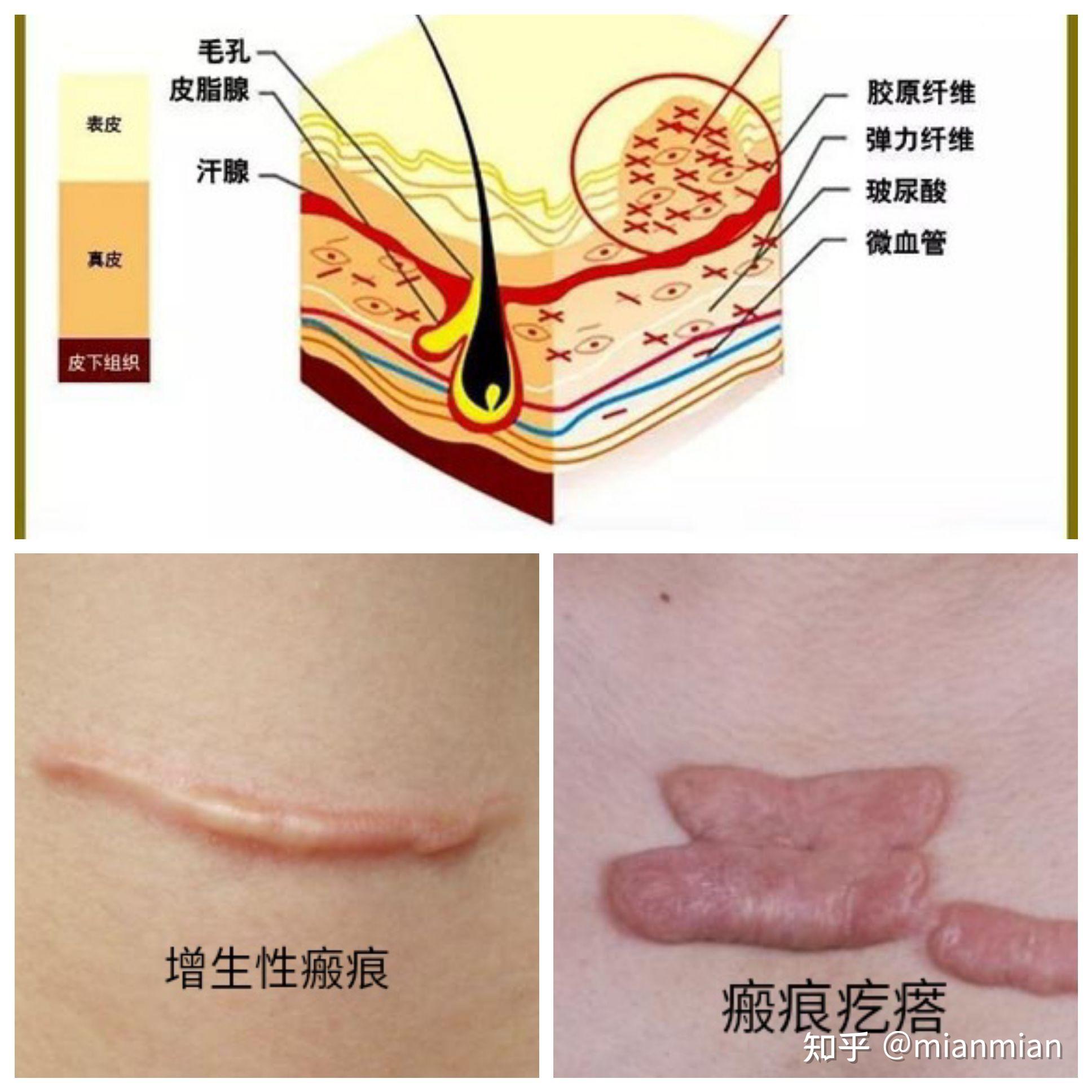 疤痕增生如何消除图片图片